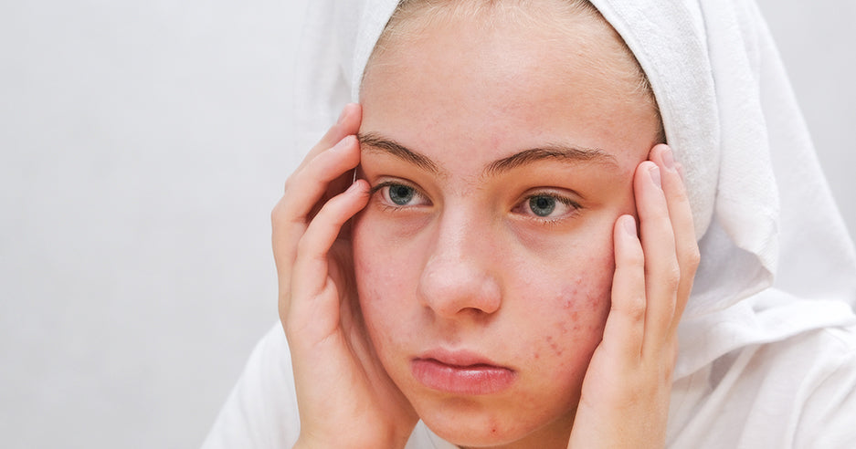 How To Get Rid of Dark Marks on Face With Glutathione